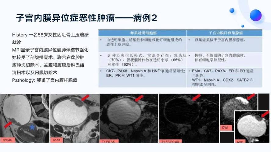 非典型鳞状细胞三年了,非典型鳞状细胞持续三年诊断指南