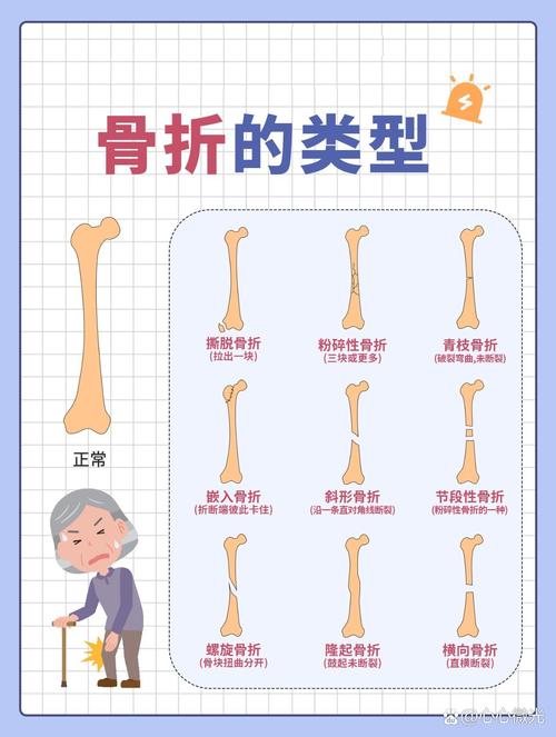 骨折和骨裂哪个恢复快,骨折与骨裂恢复速度对比